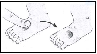 Picture of oedema assessment